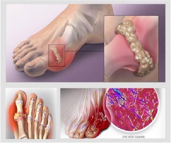 Những điều về bệnh Gout mà bạn cần phải biết