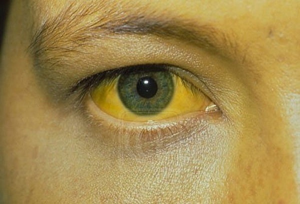 Triệu chứng mắt vàng có liên quan đến tổn hại gan hoặc có thể xảy ra do nguyên nhân khác không?
