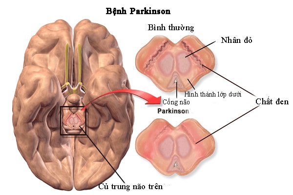 Mô tả về các triệu chứng và nguyên nhân của bệnh liệt rung Parkinson là gì?