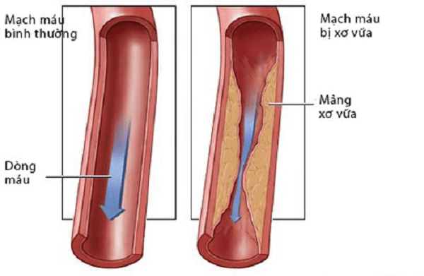 Tăng Cholesterol máu gia đình