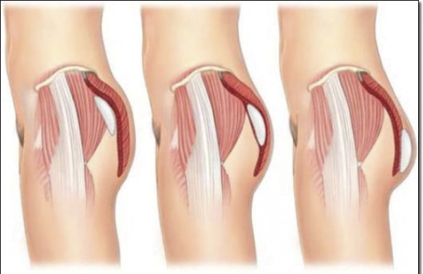 Nguyên nhân của sự phát triển không đều của mông là gì?
