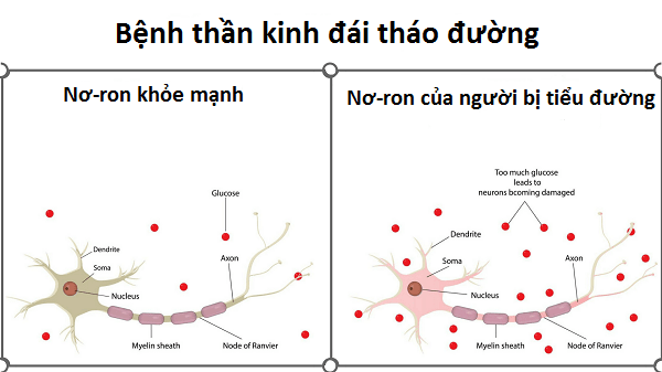 Thần kinh đái tháo đường