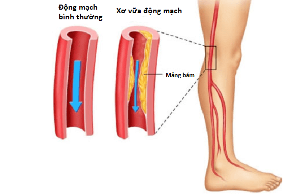 Thiếu máu chi trầm trọng