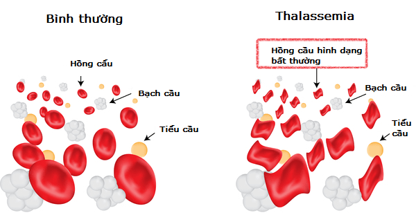 Thiếu máu Thalassemia