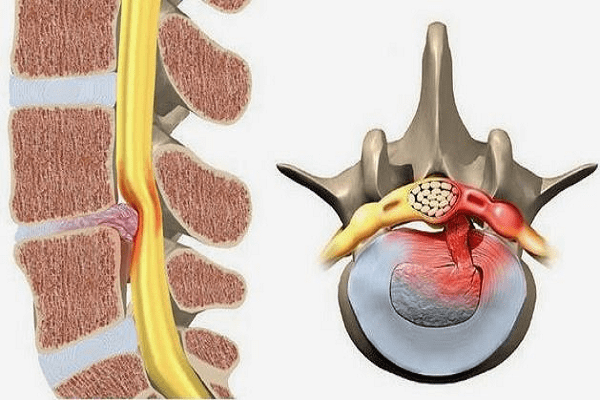 Thoát vị đĩa đệm cột sống thắt lưng