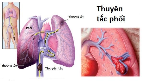 Thuyên tắc phổi