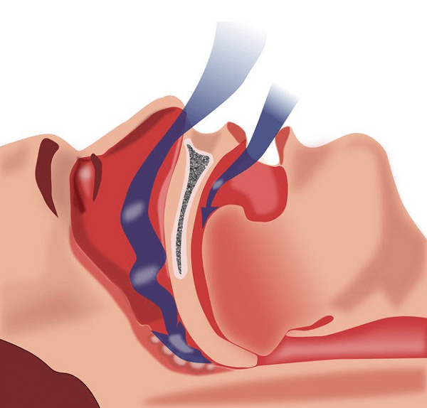 Tiết lộ bí quyết điều trị chứng ngưng thở khi ngủ