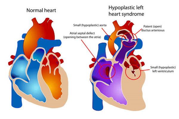 Làm thế nào để phòng ngừa bệnh tim bẩm sinh ở người lớn?