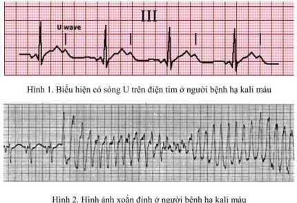 Hạ Kali trong máu là biểu hiện của bệnh gì?