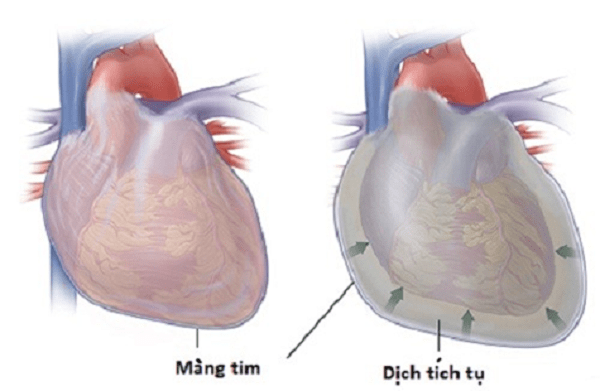 Tràn dịch màng tim
