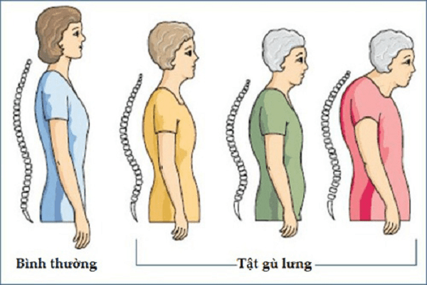 Triệu chứng, dấu hiệu, biến chứng bệnh gãy xẹp lún đốt sống