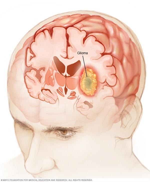 U tế bào thần kinh đệm
