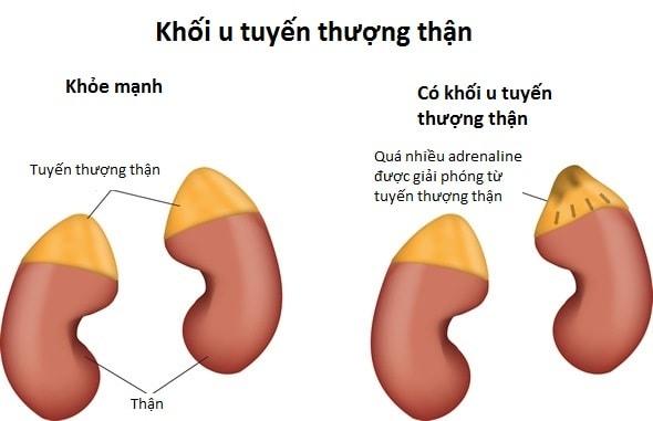U tuyến thượng thận