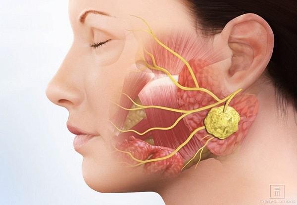 Ung thư tuyến nước bọt