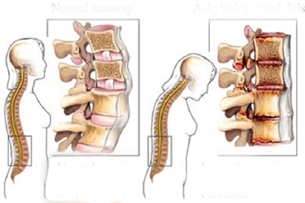 What are the complications associated with viêm cột sống dính khớp?
