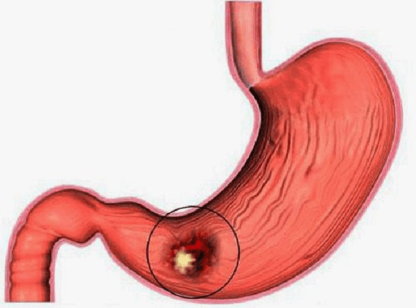 Có những yếu tố nào nên tránh khi bị viêm dạ dày mãn tính?
