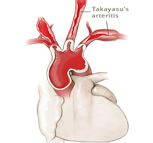 Viêm động mạch Takayasu 