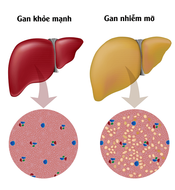 Viêm gan nhiễm mỡ NASH