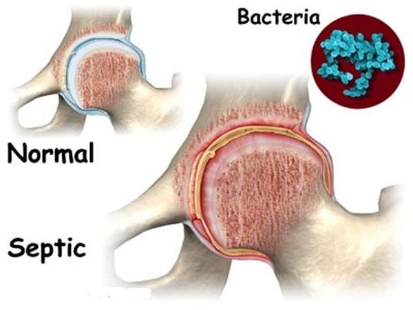 Viêm khớp nhiễm trùng