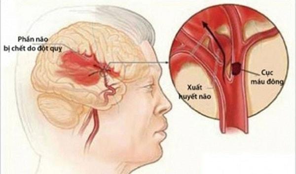 Xuất huyết não